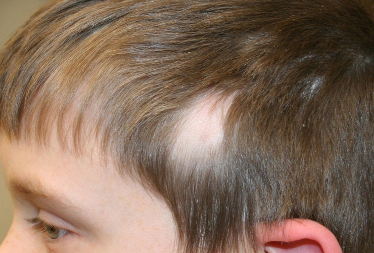 Rụng tóc ở trẻ em: Nguyên nhân, loại bệnh và cách xử lý