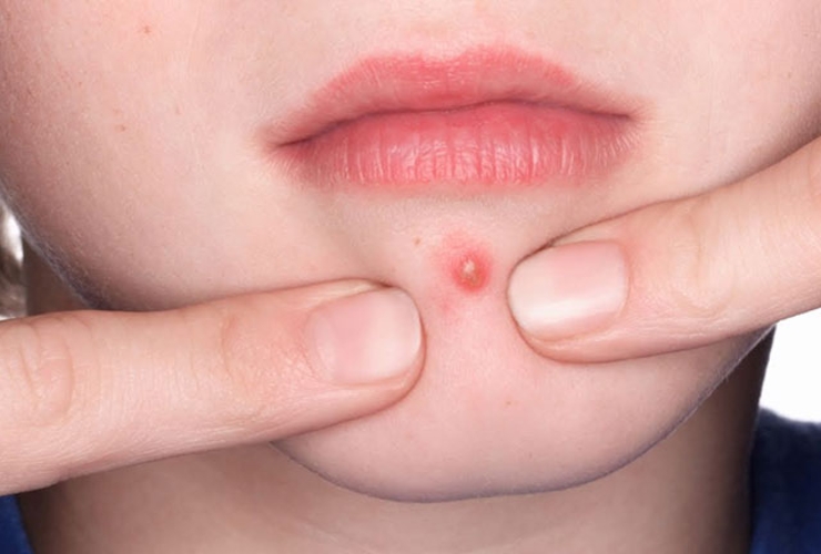 Nguyên nhân gây ra mụn nhọt và cách điều trị