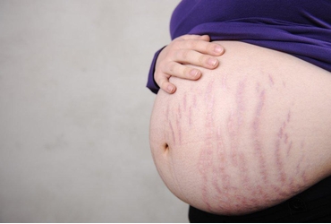Cách chống rạn da cho mẹ bầu chi tiết 2024