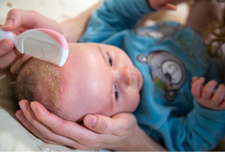 Viêm da đầu ở trẻ do viêm da cơ địa là gì? Cách khắc phục