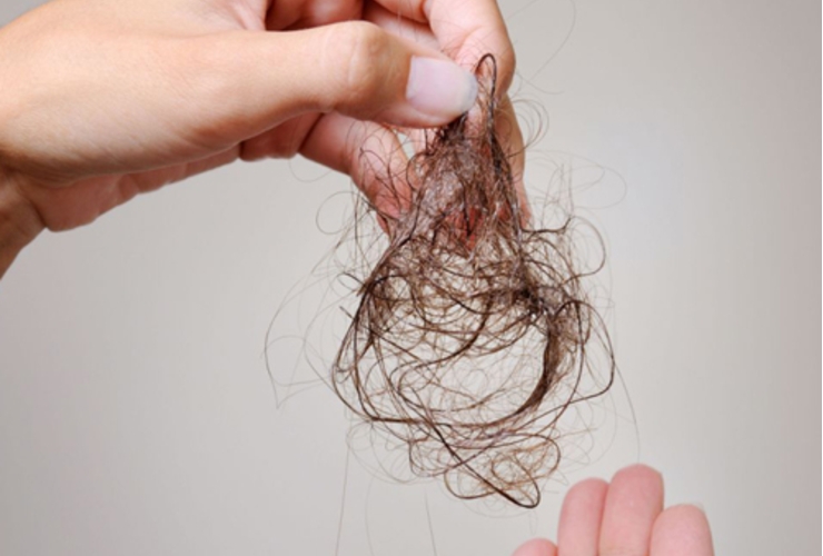 Nguyên nhân gây rụng tóc và cách khắc phục